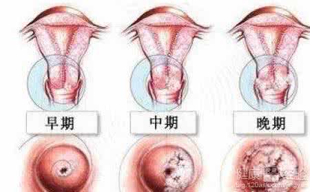 得了宫颈炎会有哪些表现