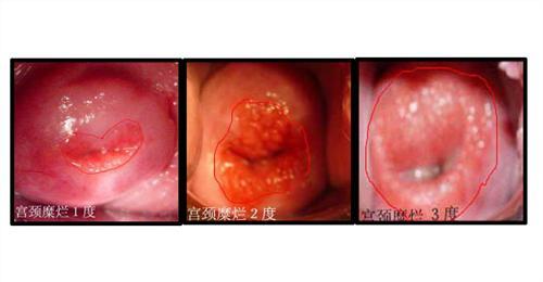 宫颈糜烂3度严重吗