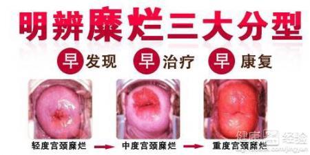 宫颈二度糜烂严重吗