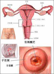 二度宫颈糜烂怎么治疗