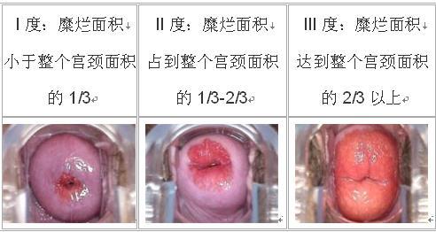 宫颈糜烂2度算严重吗