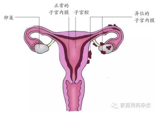 盘点常见阴道炎治疗四大误区.