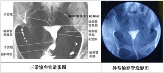 做了输卵管造影后老是感觉肚子疼是怎么回事