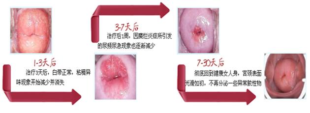 怎样治疗宫颈糜烂一度好?