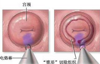 出现宫颈性不孕时有哪些症状