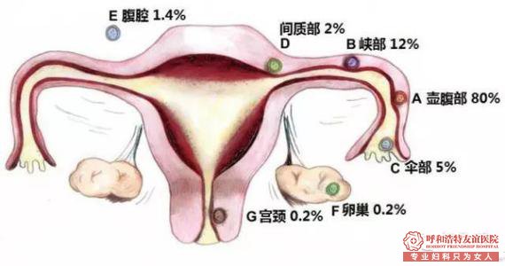 天津静海宫外孕的治疗